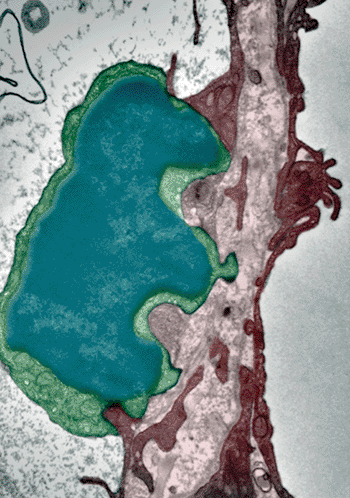 Image: Electron microscopy of a tumor cell (blue, green) on the way to extravasate through an alveolar endothelium blood capillary (purple, red). Tumor cell protrusions are seen forming their way through the endothelial cell (Photo courtesy of the University of Zurich.)